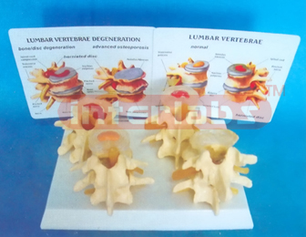 FOUR TYPE VERTEBREA NORMAL & DISEASER COMPOSITION (4 PAIRS / SET)